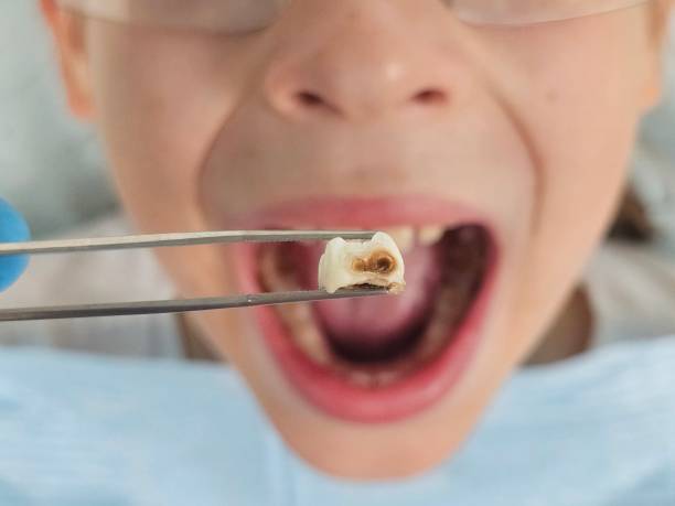 Best Emergency Treatment for Toothache in Elliston, VA